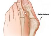 Hallux valgus et course à pied