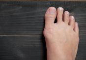 L’hallux valgus : une contre-indication à la course à pied ?